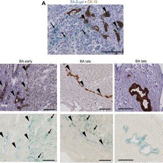 Cholangiocytes And Perinodular Hepatocytes Display Cellular Senescence