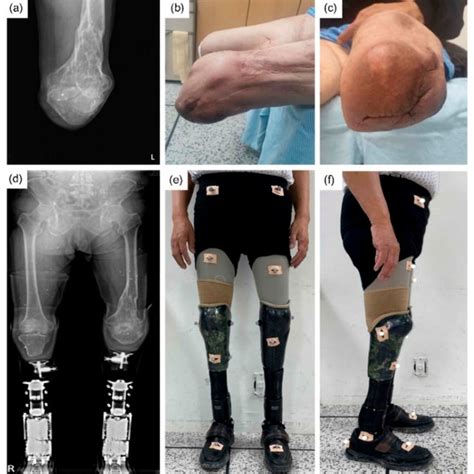 A X Ray Of Left Knee Flexion Contracture Due To Distal Femur