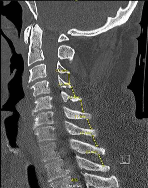 Subaxial Cervical Spine Ct Radiology Key