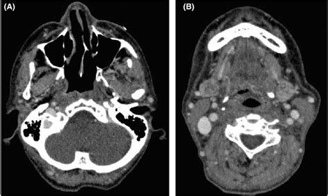 Computed Tomography Images 3 Months After Chemoradiotherapy The Images