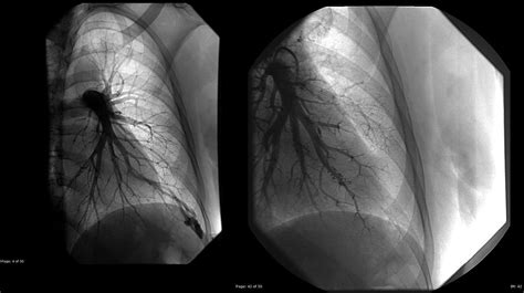 Pulmonary Avm With 3d Reconstruction Images Eurorad