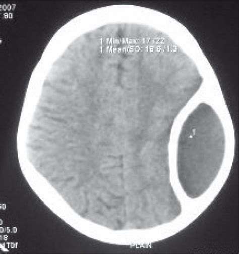 Ct Scan Axial Cuts Showing Extradural Hematoma Surround Open I