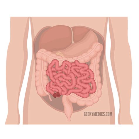 Ileostomy Diagram