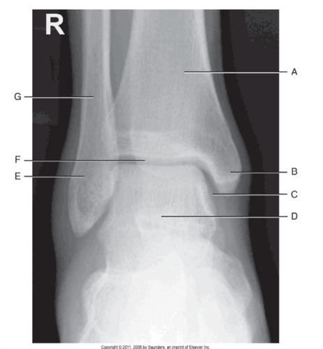 Ankle X Ray Anatomy Flashcards Quizlet