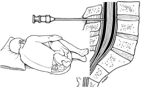 Anatomy For Lumbar Puncture Anatomy Reading Source