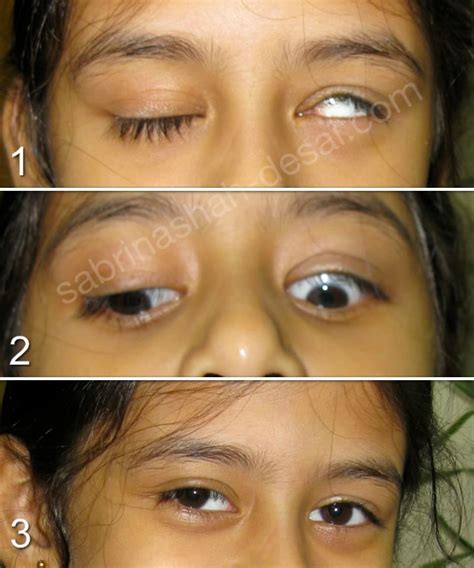 Droopy Eyelid Treatment Ptosis Surgery In London Uk Pel