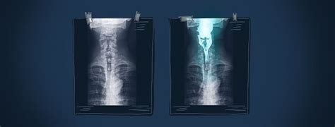 Barium Swallow Study and Myasthenia Gravis