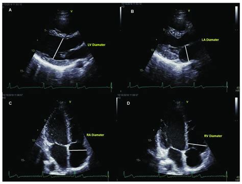 Measurements Obtained From Echocardiography Views A Parasternal