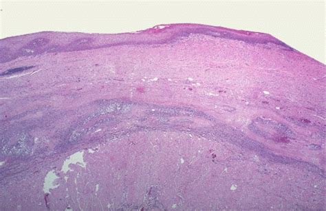 Pathology Outlines Varices