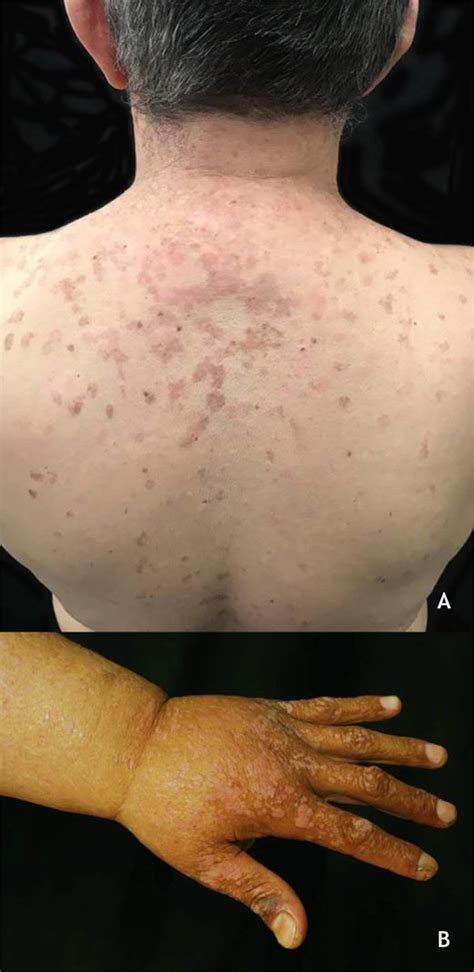 A Epidermodysplasia Verruciformis Erythematous And Or Brownish