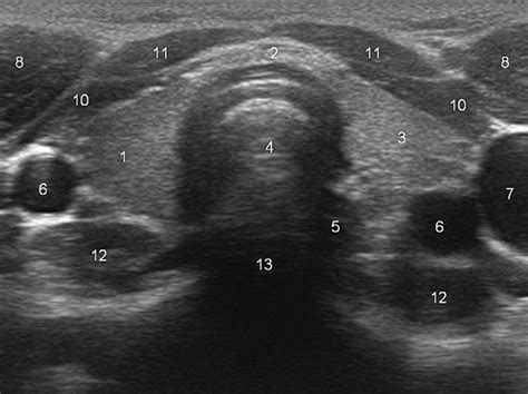 Axial Scan At The Level Of The Thyroid Showing The Right Lobe 1