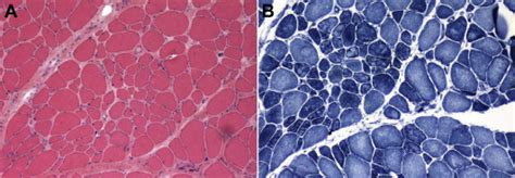 Limb Girdle Muscular Dystrophy Type A With Mutation In Capn The