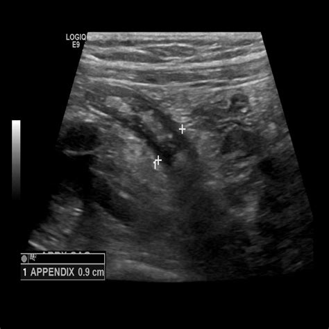 Appendix Gallery Sonographic Tendencies