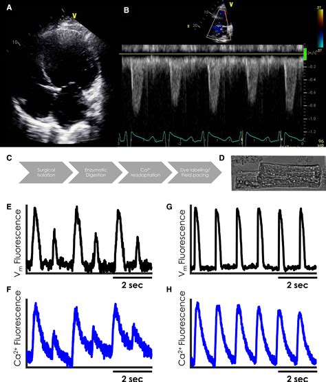 Pulsus Alternans In Cardiogenic Shock Recapitulated In Single Cell