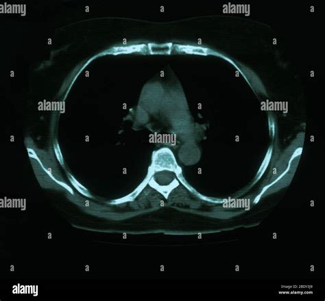 Calcification hi-res stock photography and images - Alamy