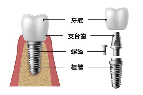 植牙過程完全攻略， 一次搞懂植牙原理！ 雅德思牙醫診所