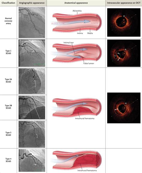 Spontaneous Coronary Artery Dissection Nejm