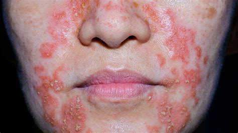 Eczema In Pictures: What Do the Types Look Like?