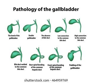 Gallbladder Disease Stages Inflammation Gallstones Cholecystitis