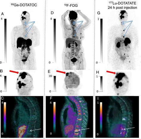 Multiparametric F Fdg And Ga Dotatoc Pet Imaging In Bone