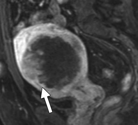 Uterine Leiomyosarcoma Can Mri Differentiate Leiomyosarcoma From