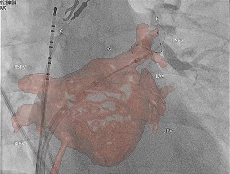 Reconstructed Image Overlay On Live Fluoroscopy Screen Occlusion