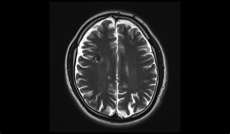 Cavernoma MRI | Radiology Article on Cavernous Hemangioma