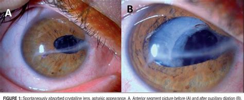 Figure From Secondary Intraocular Lens Implantation In Spontaneous