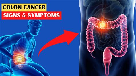 Colon Cancer Signs And Symptoms Early Warning Signs Of Colorectal Cancer Youtube