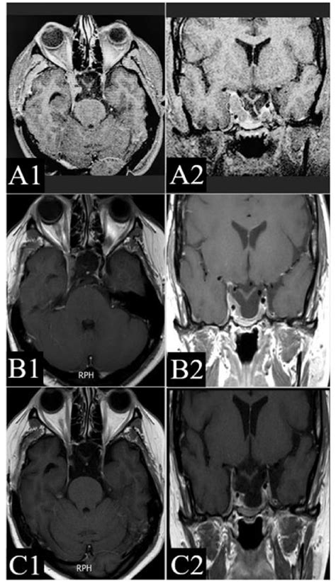 Serial Contrast Enhanced Mri Brain Images Including Gkrs Planning In