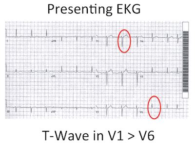 Presenting ECG Tall T wave Lead V1 - ALiEM