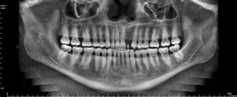 Figure From Incidental Findings From Cone Beam Computed Tomography Of