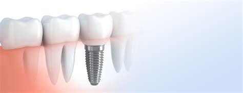 Dental Implants Leicester Forest House Dental Practice