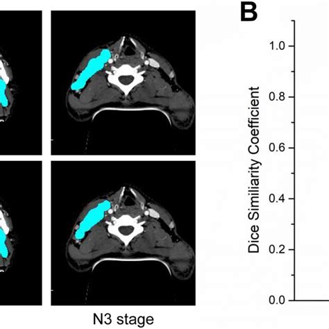 Target Delineation In T Stage Of NPC By U Net Model A Representative