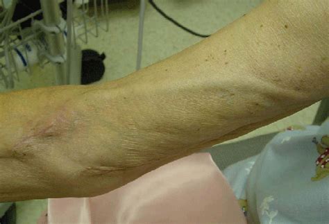 Basilic Vein Transposition