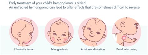 What Is Infantile Hemangioma Hemangeol