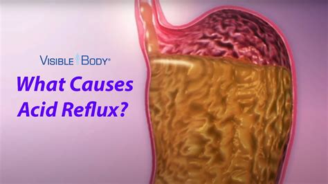 Visible Body What Causes Acid Reflux Youtube