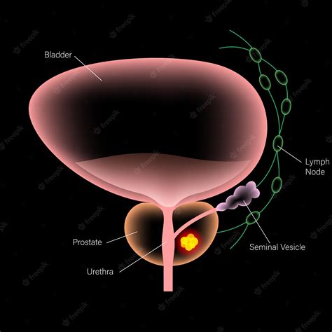 Premium Vector Prostate Cancer Concept