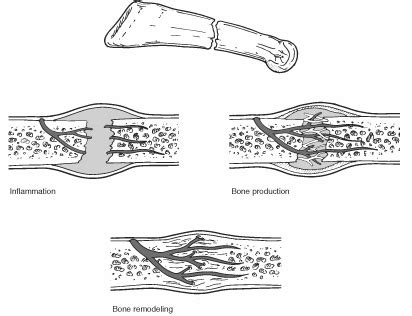 Bone Healing | Dr Debra Manheim | Step By Step Family Foot Care ...