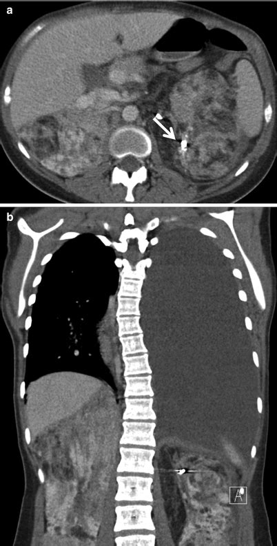 Lymphangioleiomyomatosis Thoracic Key