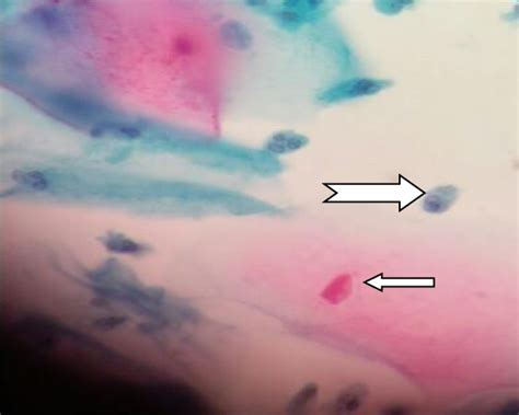 Perinuclear Halo Indicate Trichomonas Vaginalis In Pap Smear