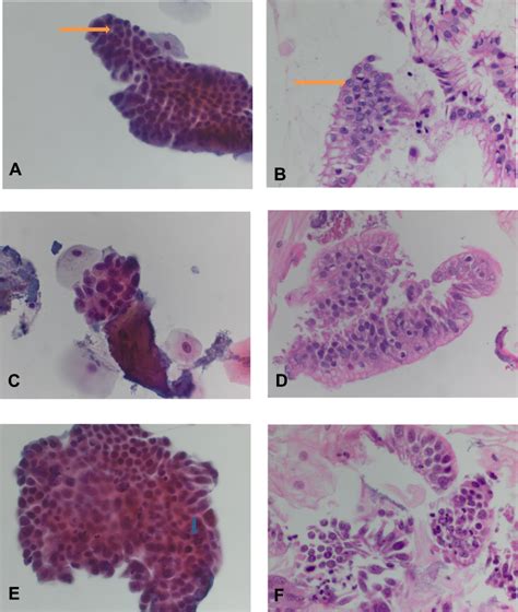 Combined EsophaCap Cytology And MUC2 Immunohistochemistry For Screenin