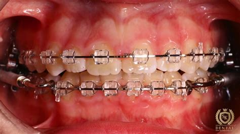 Forsus Class Ii Correctionmandibular Advancement Youtube