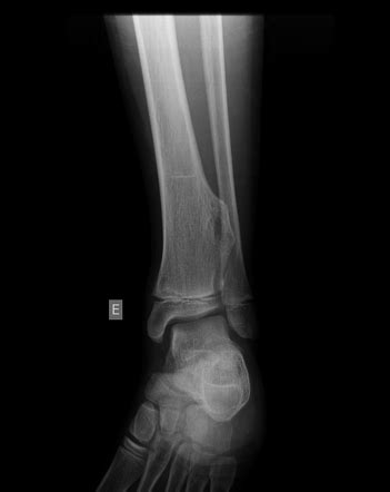 Hereditary Multiple Exostoses Osteochondromatosis Image