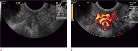 Gray Scale A And Power Doppler B Sonograms Show The Swirling Of The