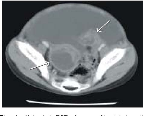 Figure From A Case Of Abdominal Tuberclosis Mimicking Ovarian Cancer