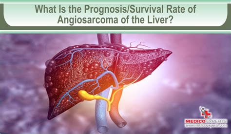 What You Need To Know About Angiosarcoma Of The Liver