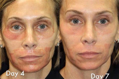 Laser Resurfacing Archives Cosmetic Dermatology Miami FL