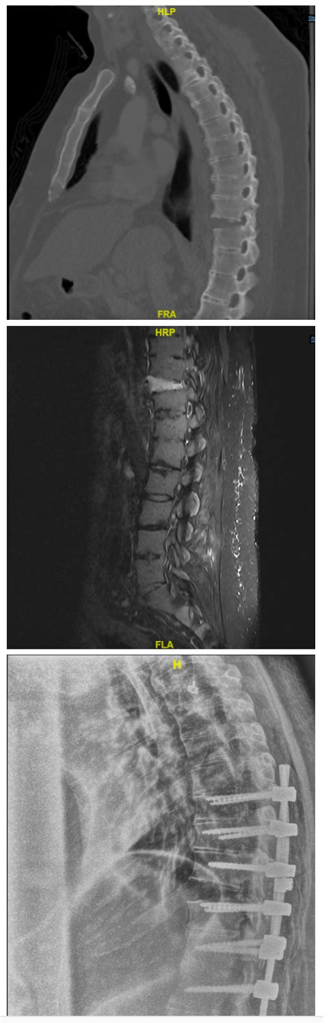 Management Of Thoracolumbar Vertebral Fractures And Dislocations In