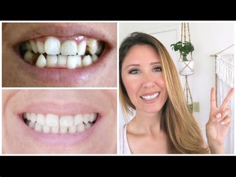 Invisalign Before And After Beach Braces Orthodontic Specialists